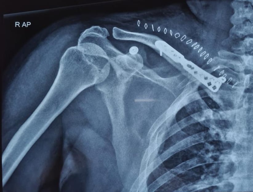 Displaced clavicle fracture